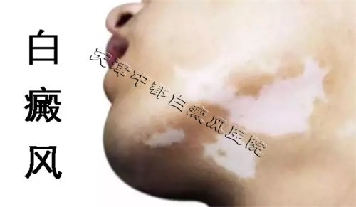 白癜風(fēng)初期有什么癥狀呢？