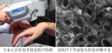 白癜風(fēng)初期有什么癥狀呢？