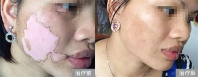 適合白癜風(fēng)的飲食有哪些呢?