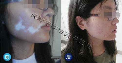 患上白癜風能治療嗎？