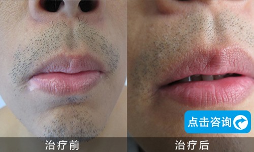 口角白癜風