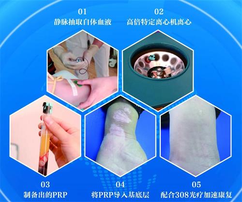 自體黑色素細胞再生技術（ACR）