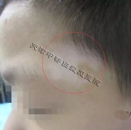 天津白癜風醫院